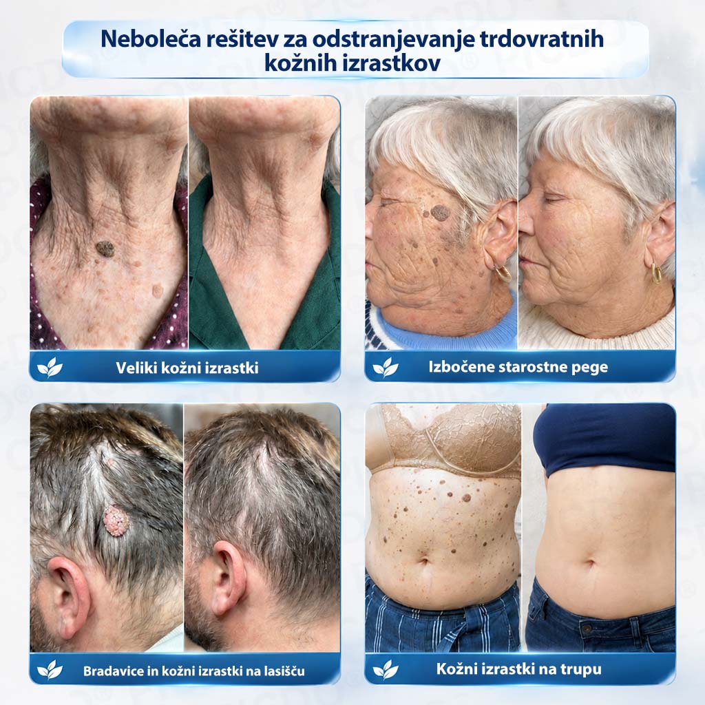 𝐏𝐢𝐜𝐝𝐨®🧑‍⚕️ 𝟕-𝐝𝐧𝐞𝐯𝐧𝐚 𝐤𝐫𝐞𝐦𝐚 𝐩𝐫𝐨𝐭𝐢 𝐤𝐨ž𝐧𝐢𝐦 𝐢𝐳𝐫𝐚𝐬𝐭𝐤𝐨𝐦 & 𝐩𝐢𝐠𝐦𝐞𝐧𝐭𝐧𝐢𝐦 𝐥𝐢𝐬𝐭𝐚𝐦𝐢 (Brezbolestna formula – brez brazgotin)🎋4️⃣