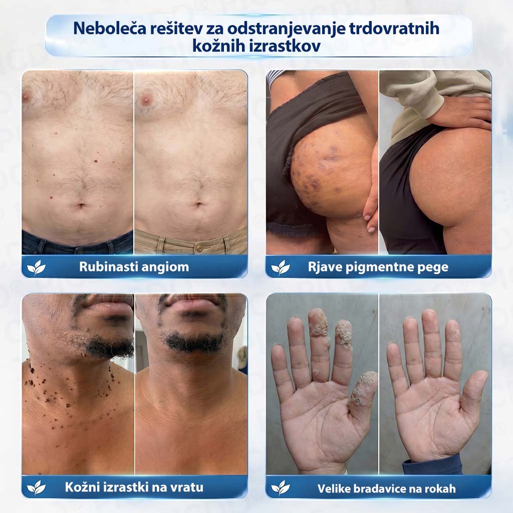 𝐏𝐢𝐜𝐝𝐨®🧑‍⚕️ 𝟕-𝐝𝐧𝐞𝐯𝐧𝐚 𝐤𝐫𝐞𝐦𝐚 𝐩𝐫𝐨𝐭𝐢 𝐤𝐨ž𝐧𝐢𝐦 𝐢𝐳𝐫𝐚𝐬𝐭𝐤𝐨𝐦 & 𝐩𝐢𝐠𝐦𝐞𝐧𝐭𝐧𝐢𝐦 𝐥𝐢𝐬𝐭𝐚𝐦𝐢 (Brezbolestna formula – brez brazgotin)🎋4️⃣