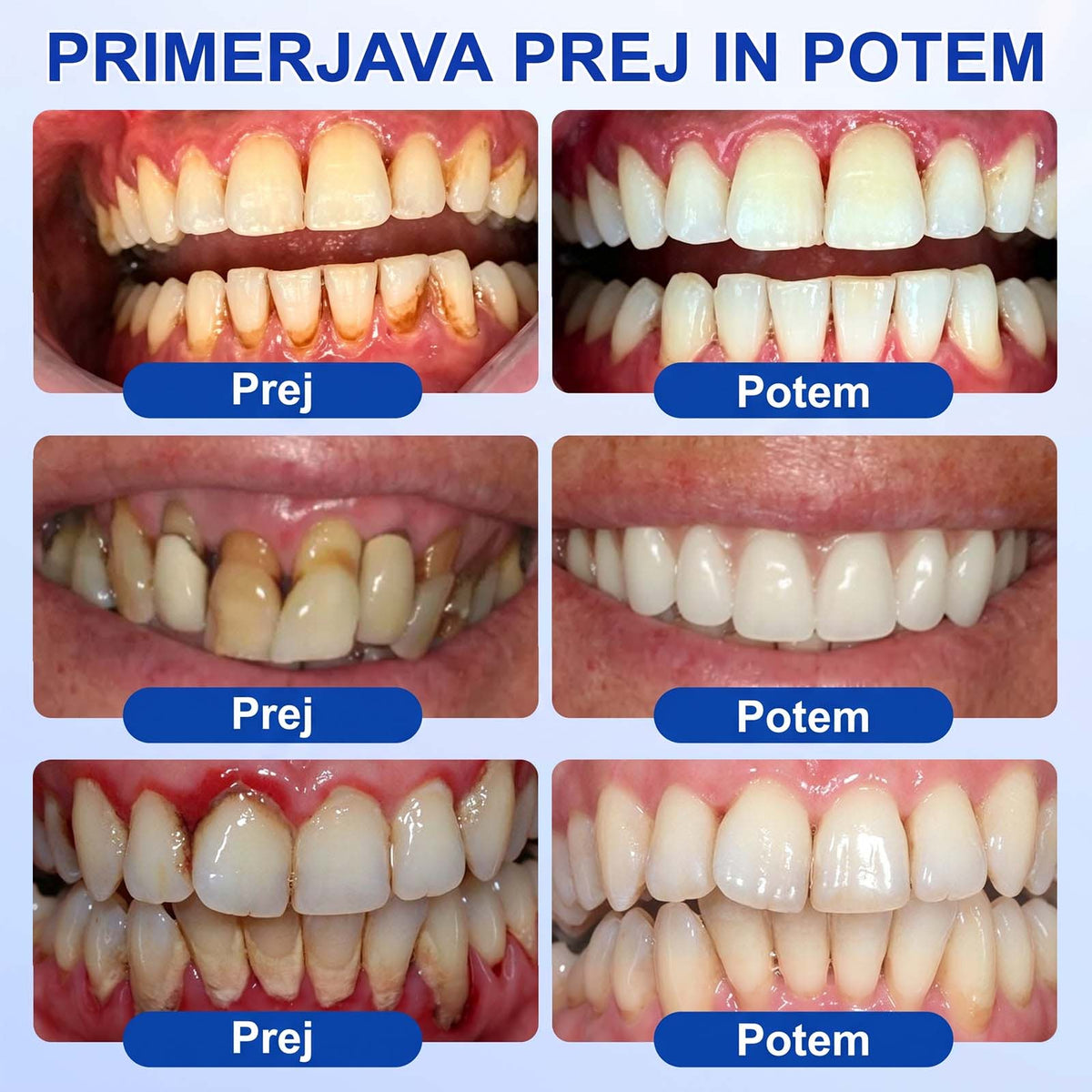 🦷 Evolvion® GumRevive gel za obnovo parodontalnega tkiva🍓3️⃣