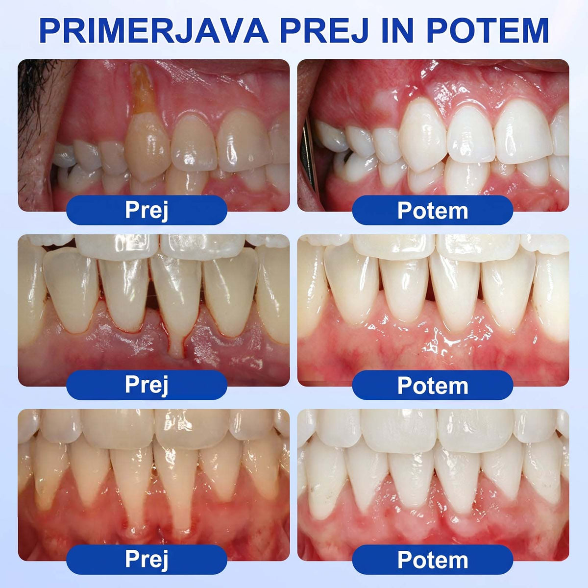 🦷 Evolvion® GumRevive gel za obnovo parodontalnega tkiva🍓3️⃣