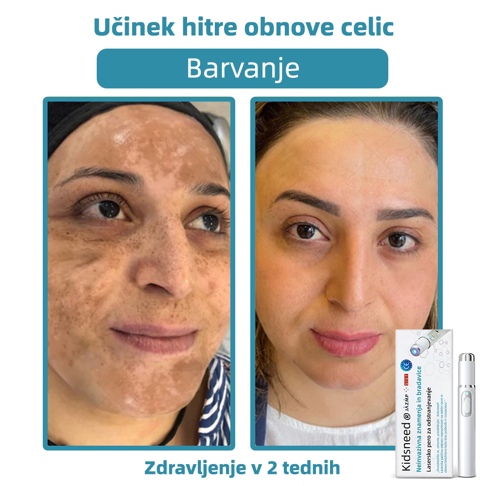KIDSNEED®💃 Neinvazivno lasersko pero za odstranjevanje kretenj in bradavic - močno🔥🔥🔥Priporočilo Slovenskega dermatološkega društva (SDD)