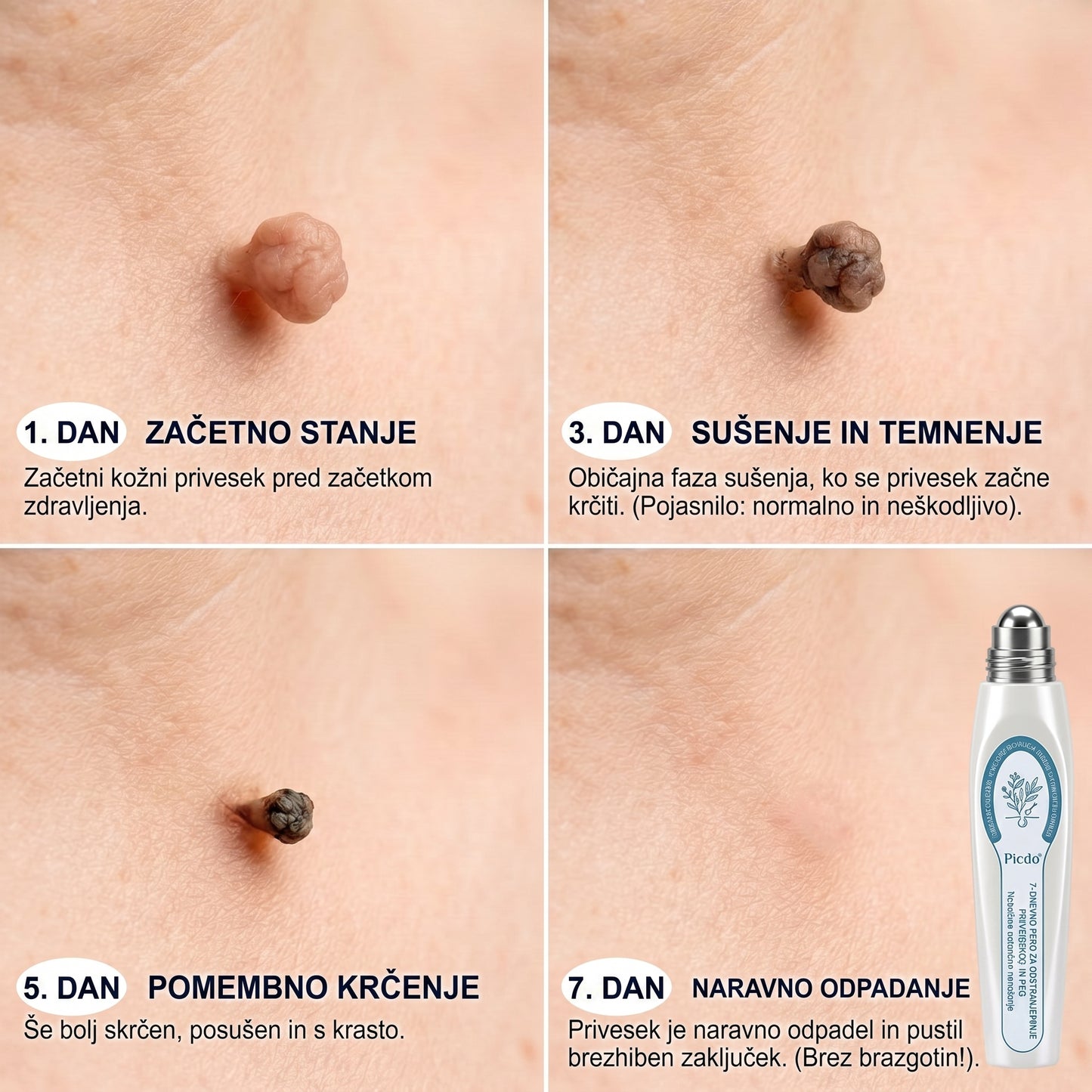 Uradna trgovina | ✅👩‍⚕️ 𝐏i𝐜𝐝o® 7-dnevni 𝗧𝗮𝗴 & 𝗦𝗽𝗼𝘁 𝐄𝐫𝐚𝘀𝐞𝐫 (Brez bolečin, brez brazgotin – valjčni aplikator) 🎉