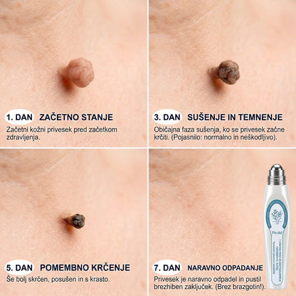 Uradna trgovina | ✅👩‍⚕️ 𝐏i𝐜𝐝o® 7-dnevni 𝗧𝗮𝗴 & 𝗦𝗽𝗼𝘁 𝐄𝐫𝐚𝘀𝐞𝐫 (Brez bolečin, brez brazgotin – valjčni aplikator) 🎉